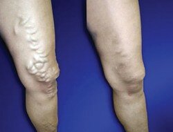 Before and After Endovenous Laser Therapy (EVLT).